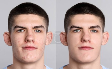 Téléchargez les photos : Problème d'acné. Jeune homme avant et après traitement sur fond gris, collage de photos - en image libre de droit