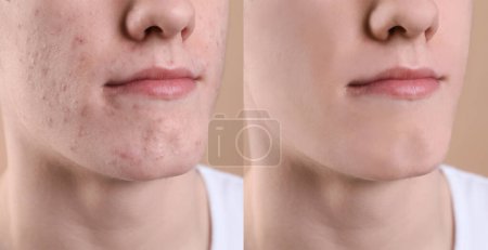 Téléchargez les photos : Problème d'acné. Jeune homme avant et après traitement sur fond beige, gros plan. Collage de photos - en image libre de droit