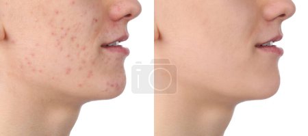 Téléchargez les photos : Problème d'acné. Jeune homme avant et après traitement sur fond blanc, gros plan. Collage de photos - en image libre de droit