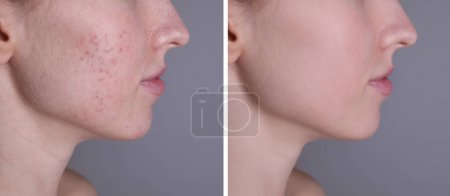 Téléchargez les photos : Problème d'acné. Jeune femme avant et après traitement sur fond gris, gros plan. Collage de photos - en image libre de droit