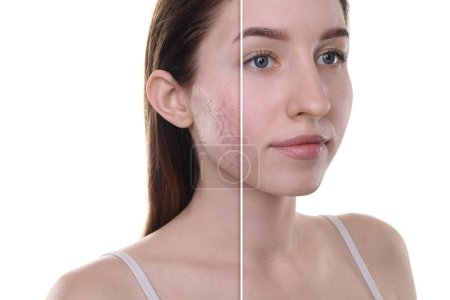 Téléchargez les photos : Problème d'acné, collage. Photo de la femme divisée en deux avant et après le traitement sur fond blanc - en image libre de droit