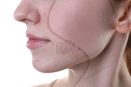 Téléchargez les photos : Problème d'acné, collage. Photo de la femme divisée en deux avant et après le traitement sur fond blanc, gros plan - en image libre de droit