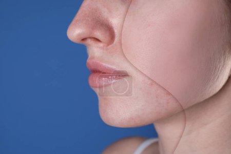Téléchargez les photos : Problème d'acné, collage. Femme avant et après le traitement sur fond bleu, gros plan. Espace pour le texte - en image libre de droit