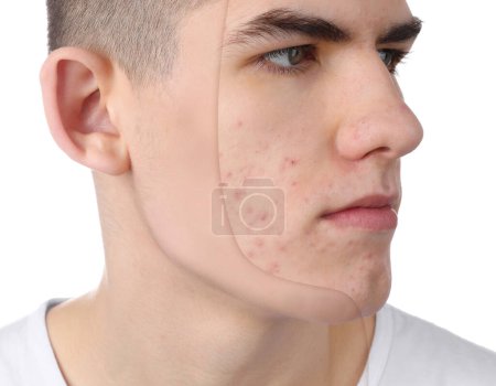 Téléchargez les photos : Problème d'acné, collage. Photo de l'homme divisé en deux avant et après le traitement sur fond blanc - en image libre de droit