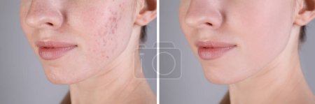 Téléchargez les photos : Problème d'acné. Jeune femme avant et après traitement sur fond gris, gros plan. Collage de photos - en image libre de droit