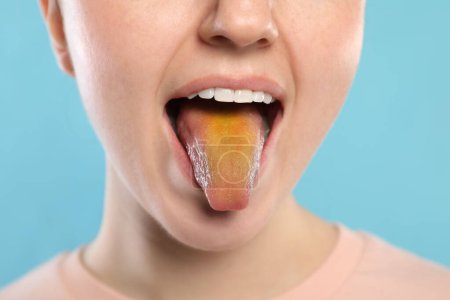 Foto de Enfermedades gastrointestinales. Mujer mostrando su lengua amarilla sobre fondo azul claro, primer plano - Imagen libre de derechos