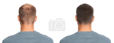Man before and after hair treatment with high frequency darsonval device on white background, back view. Collage of photos
