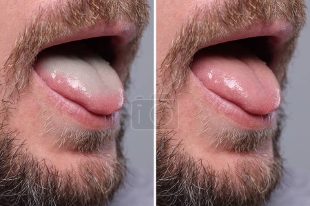 Photo for Man showing his tongue before and after cleaning procedure, closeup. Tongue coated with plaque on one side and healthy on other, collage - Royalty Free Image