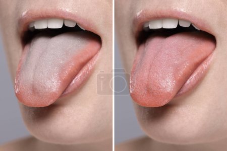 Frau zeigt ihre Zunge vor und nach der Reinigung, Nahaufnahme. Zunge auf der einen Seite mit Plaque überzogen und auf der anderen gesund, Collage