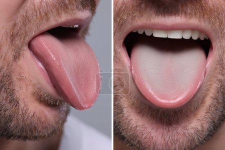 Mann zeigt seine Zunge vor und nach der Reinigung, Nahaufnahme. Zunge auf der einen Seite mit Plaque überzogen und auf der anderen gesund, Collage