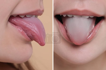 Photo for Woman showing her tongue before and after cleaning procedure, closeup. Tongue coated with plaque on one side and healthy on other, collage - Royalty Free Image