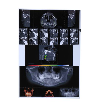 X-ray scans of human maxillofacial section for dental analysis isolated on white