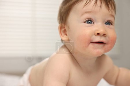 Niedliches kleines Baby mit allergischer Rötung auf den Wangen im Haus