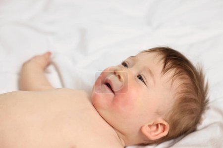 Cute little baby with diathesis symptom on bed indoors