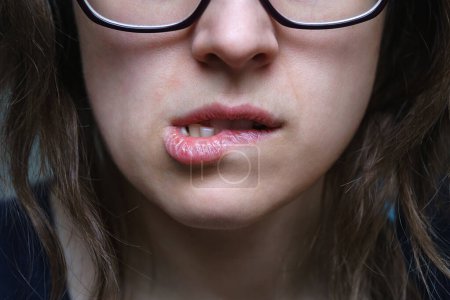 Téléchargez les photos : Image recadrée de femmes visage mordant la peau sur les lèvres gercées sèches - en image libre de droit