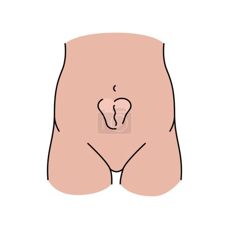 Illustration for Incisional hernia line icon. Vector isolated element. - Royalty Free Image