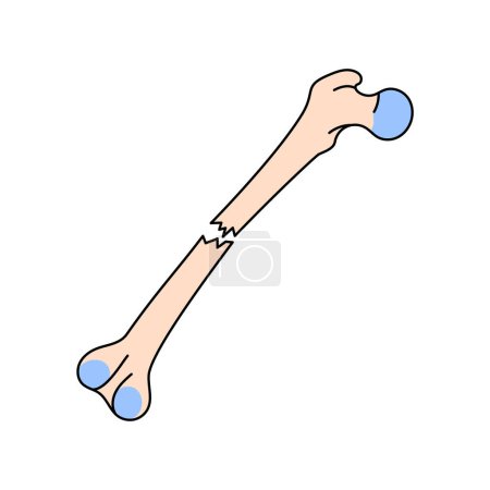 Ilustración de Icono de línea de fractura ósea cerrada. - Imagen libre de derechos
