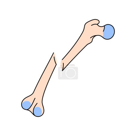 Illustration for Oblique displaced bone fracture line icon. - Royalty Free Image