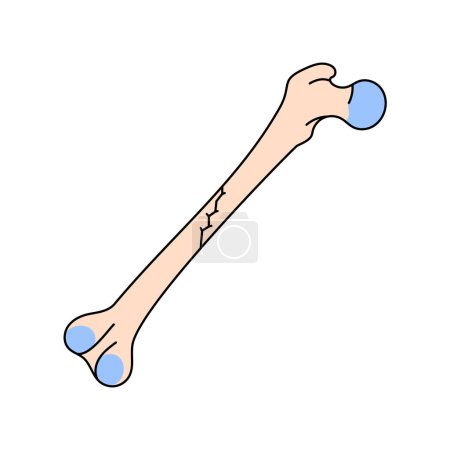 Ilustración de Icono de línea de fractura ósea oblicua no desplazada. - Imagen libre de derechos