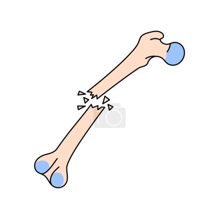 Ilustración de Icono de línea de fractura ósea abierta. - Imagen libre de derechos
