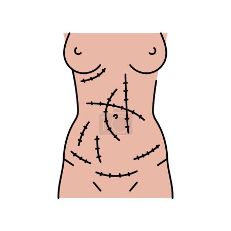 Ilustración de Icono de línea de incisiones abdominales. - Imagen libre de derechos