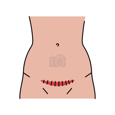Ilustración de Icono de línea de incisión de Pfannenstiel. Incisiones abdominales. - Imagen libre de derechos