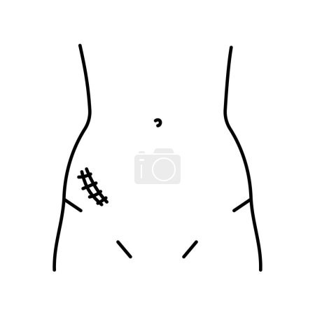 Ilustración de Icono de línea de incisión de McBurney. Incisiones abdominales. - Imagen libre de derechos
