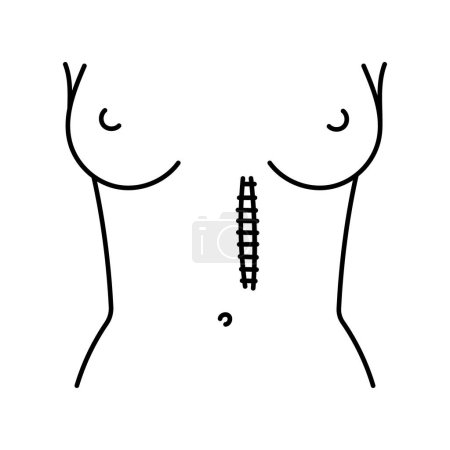 Téléchargez les illustrations : Icône de ligne d'incision paramédienne. Incisions abdominales. - en licence libre de droit