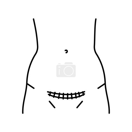 Téléchargez les illustrations : Icône de ligne d'incision Pfannenstiel. Incisions abdominales. - en licence libre de droit