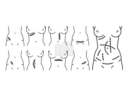 Ilustración de Conjunto de iconos de línea de incisiones abdominales. - Imagen libre de derechos