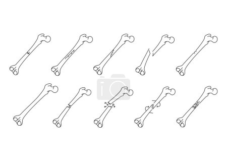 Bone fracture line icons set. Vector isolated element. 
