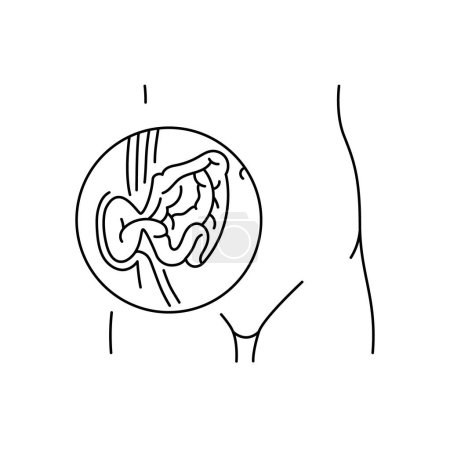 Icono de línea de hernia estrangulada. Elemento aislado del vector.