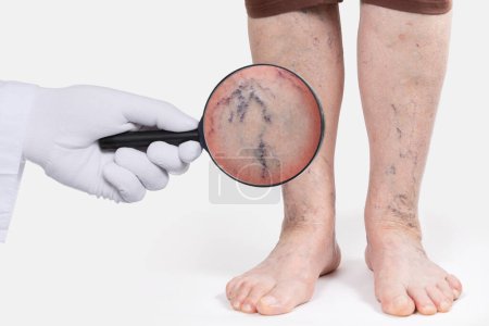 La main du médecin dans un gant blanc montre une inflammation zoomée des vaisseaux sanguins avec une loupe sur les vieux pieds féminins. Concept de varices et de varicosités.