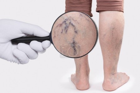 Doctor's hand in a white glove shows zoomed blood vessels with a magnifying glass. Old woman with vascular asterisks on her legs. Rear view. The concept of varicose veins.