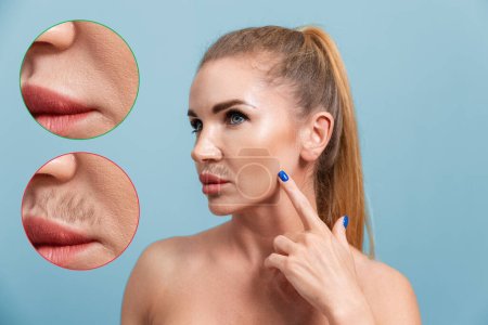 Portrait of a young Caucasian woman pointing to a mustache above her upper lip. The result before and after the epilation procedure. Blue background. The concept of hair removal.