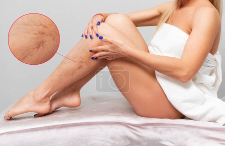 Téléchargez les photos : Fit woman sits and shows vascular asterisks on her lower leg. Side view. Enlarged area with blood vessels. The concept of varicose veins and varicosity. - en image libre de droit