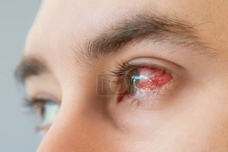 Acercamiento de los ojos pardos masculinos inyectados en sangre y enrojecimiento con vasos. Concepto de queratitis, inflamación y oftalmología.