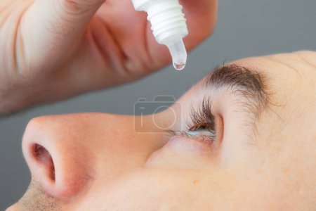 Foto de Ophthalmology. A man instills medicine into his eye. Close-up. The concept of irritation and dryness, eye diseases. - Imagen libre de derechos