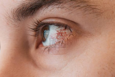 Foto de Oftalmología. Ojo humano de cerca con malla vascular roja e inflamación en el globo ocular. El concepto de conjuntivitis y queratitis. - Imagen libre de derechos