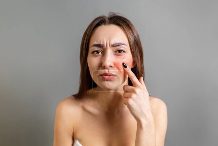 The concept of rosacea. A Caucasian brunette woman points a finger at a red cheek with inflammation. Copy space. Gray background.