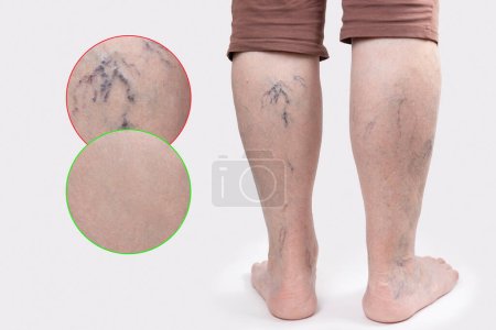 Varicosity. Close up side view of old feet of woman with vascular asterisks. Rear view. Zoomed area with blood vessels. White background. The concept of varicose veins.