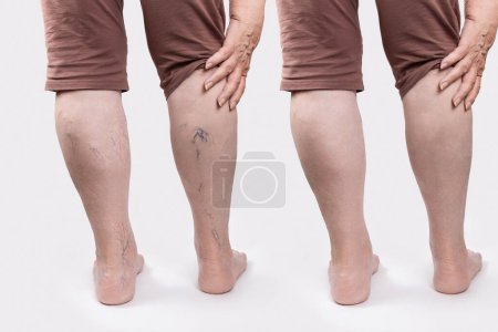 Varicosity. Primer plano de piernas viejas de mujer con asteriscos vasculares. Vista trasera. Resultados antes y después del tratamiento con láser. Fondo blanco. El concepto de varices.