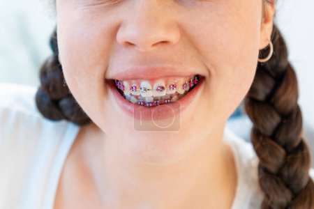 Téléchargez les photos : Gros plan de la jeune femme souriante avec des bretelles sur les dents blanches. Concept d'orthodontie, de soins dentaires et de malocclusion. - en image libre de droit