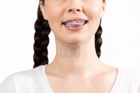 Photo for Close-up of smiling young woman with braces on her teeth. White background. Concept of orthodontic treatment. - Royalty Free Image