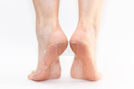 Photo for Rear close up view of female feet with peeling soles skin on heels. White background. Skin care and pedicure. - Royalty Free Image