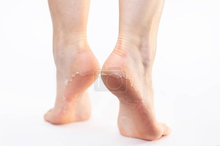 Rückansicht weiblicher Füße mit abblätternder Haut auf Absätzen, auf weißem Hintergrund. Hautpflege und Peeling der Beinsohlen.