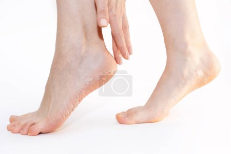 Photo for Side view of woman's legs and hand touches flaky skin heels on white background. Concept of pedicure and cosmetology. - Royalty Free Image