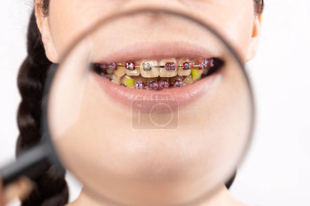 Photo for Close up of young Caucasian woman with brackets on dirty teeth. Zoomed view through magnified glass. Concept of dental care during orthodontic treatment. - Royalty Free Image
