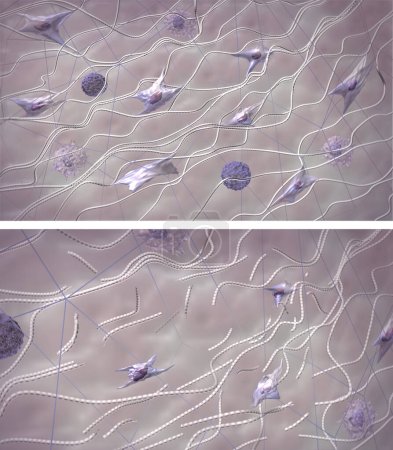 Fibres de collagène chez les jeunes peaux saines et vieillissantes Processus destructeur. Comparaison de la structure de la matrice extracellulaire cutanée. Illustration médicale 3D