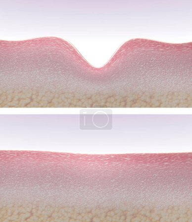 Téléchargez les photos : Wrinkled and smooth skin. 3D rendered illustration showing the skin tissues cross-section before and after anti-aging wrinkle reduction treatment. Skin and collagen regeneration - en image libre de droit